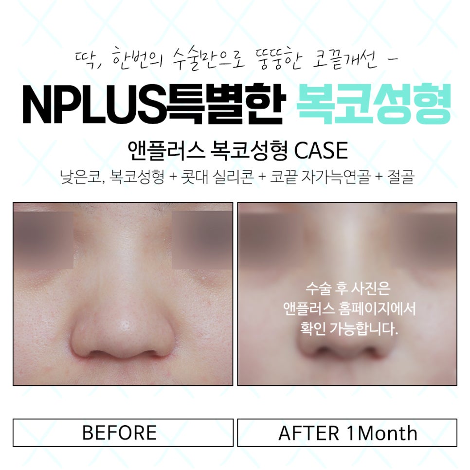 복코수술후기를 더욱 자세히 확인하고 관련 이미지 14