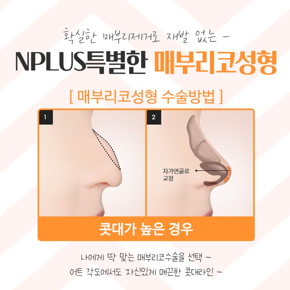 Hump Nose Surgery Review with a Clear Diagnosis image 9