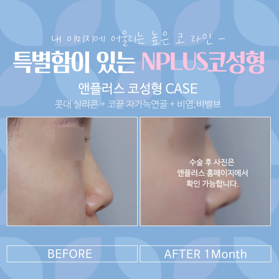 여자코수술후기 코 내부까지 확인하고 관련 이미지 18