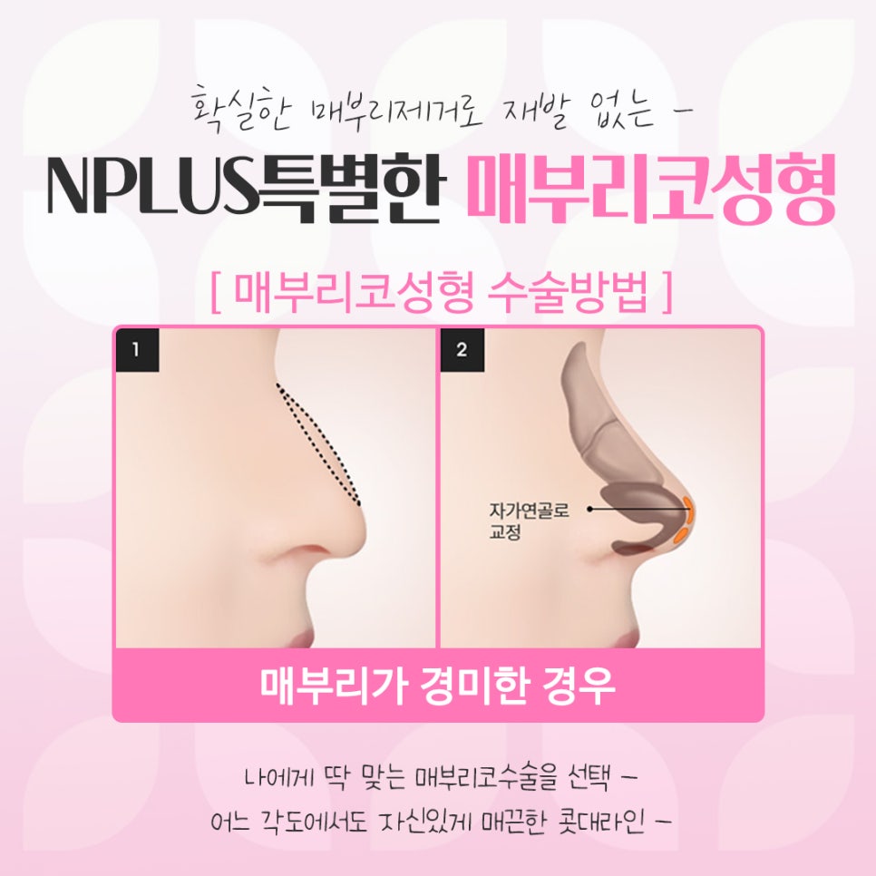 매부리코수술전후 비교를 한다면 관련 이미지 10