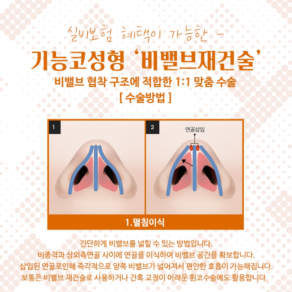 비밸브협착증 코수술방법 완벽 정리 관련 이미지 9