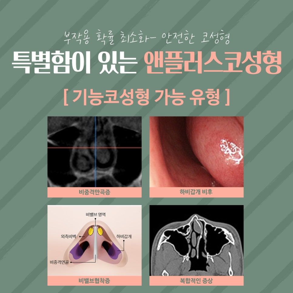 Beautiful and Natural with Autologous Cartilage Rhinoplasty image 11