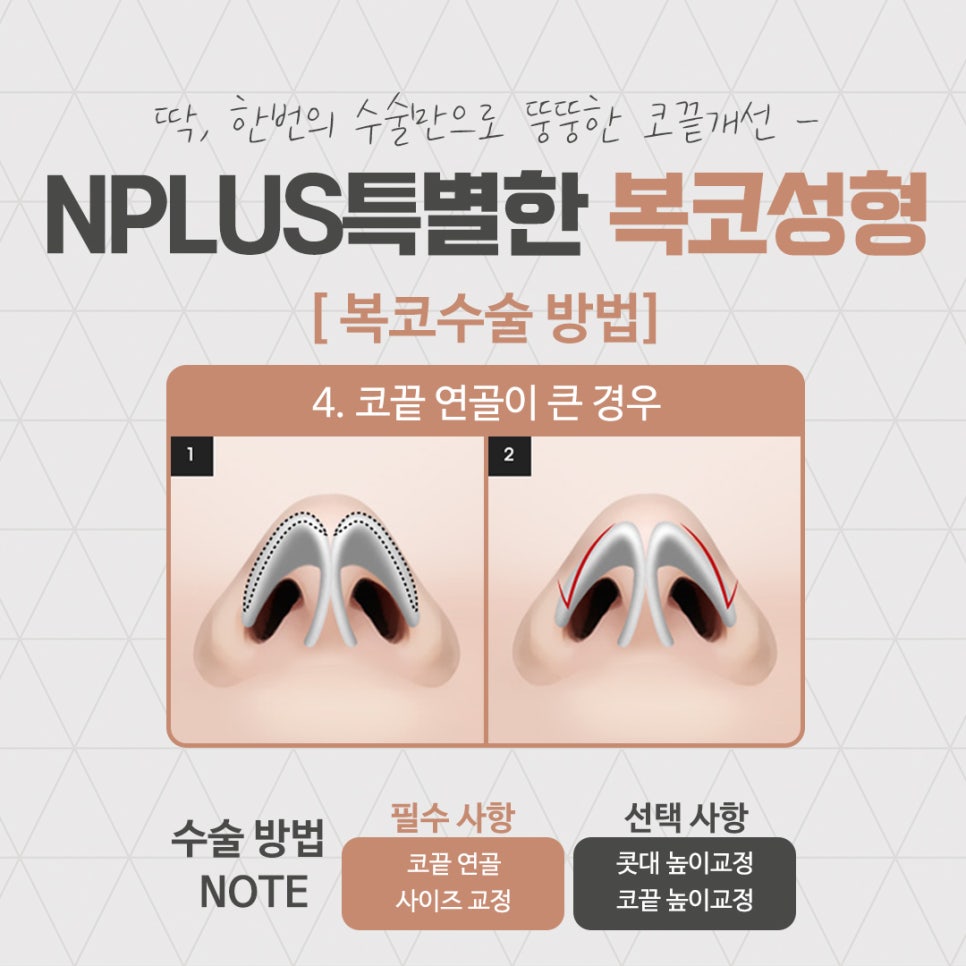 복코성형후기를 다양하게 찾아보고 관련 이미지 11