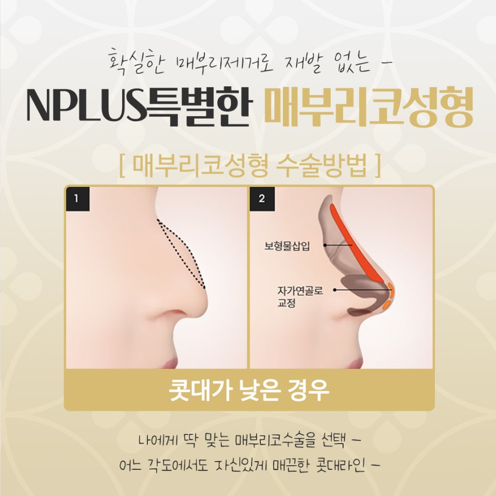 매부리코수술후기 확실하게 확인하여 관련 이미지 9