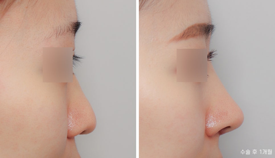 Creating a Straight-But-Slightly-Curved Nose Line with Columella Reduction image 5