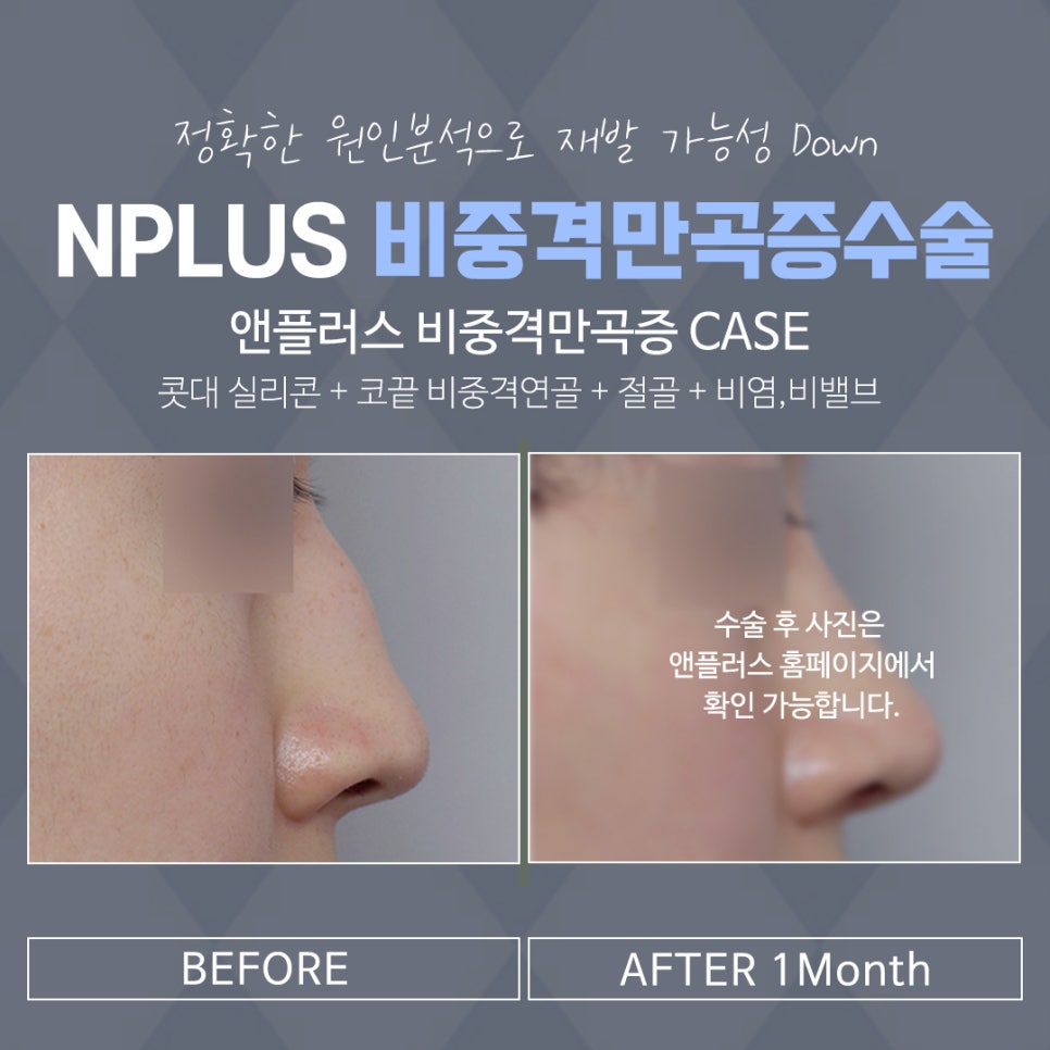 비중격코성형 정확한 원인 파악으로 관련 이미지 14