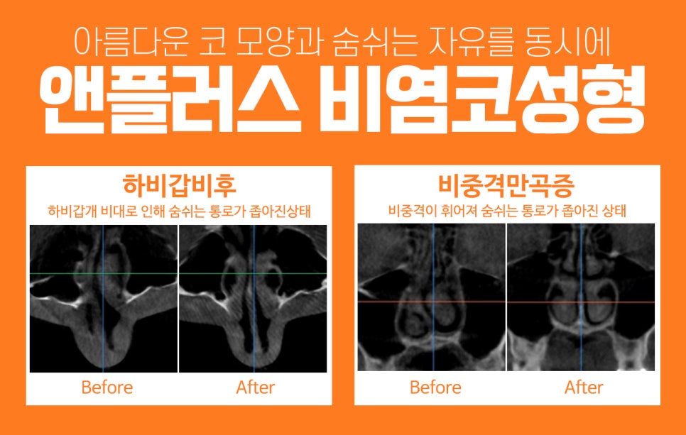 Breathing Freedom and a Beautiful Nose Shape at A+ Clinic at the Same Time image 2