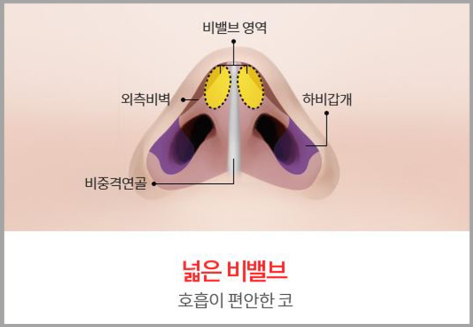 비염코성형? 어렵지 않아요. 관련 이미지 10