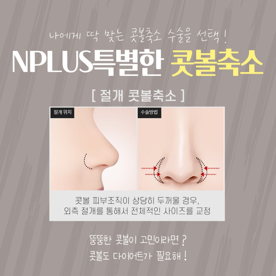 Postoperative Review of Nostril Reduction Surgery: If You’re Worried About Wide Nostrils image 10