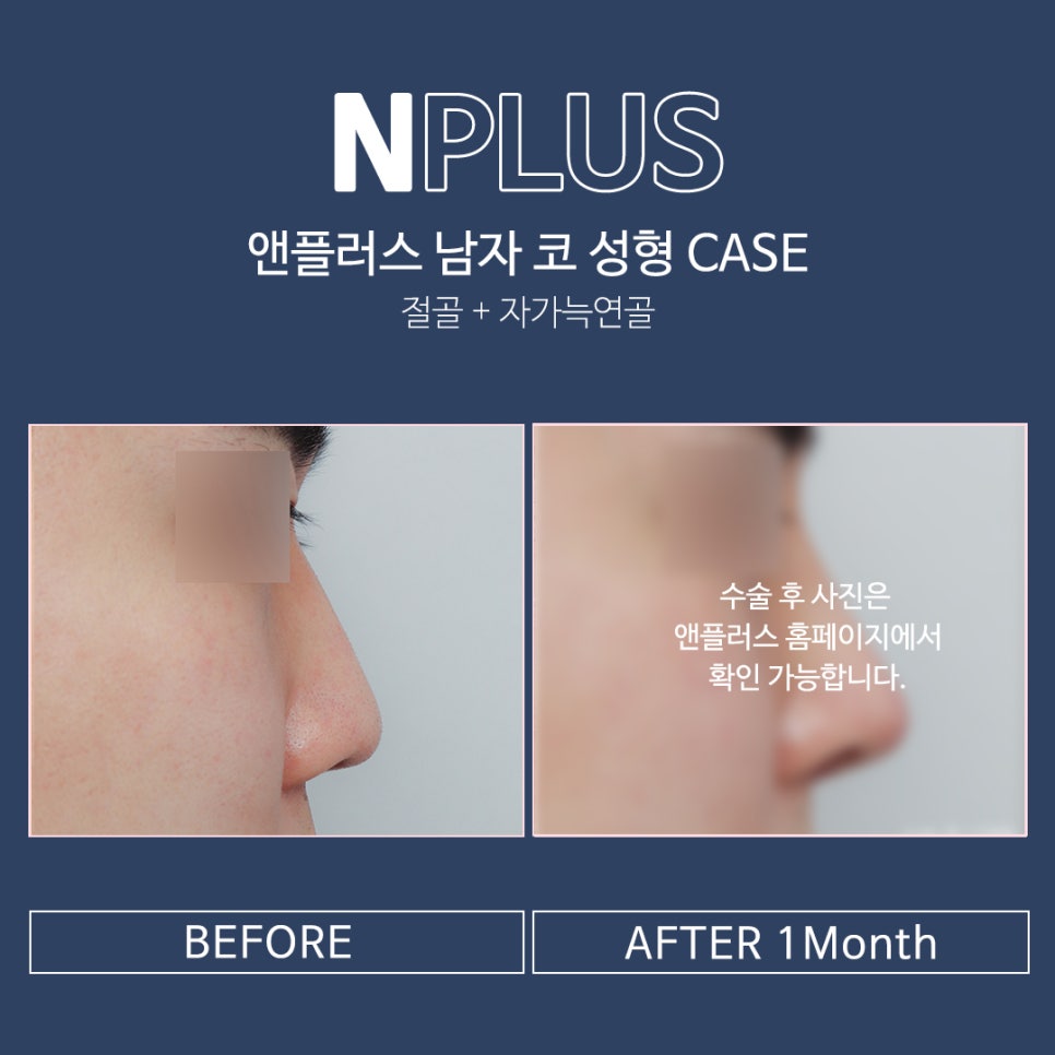 Male Rhinoplasty Review: Taking Functional Aspects into Consideration image 7