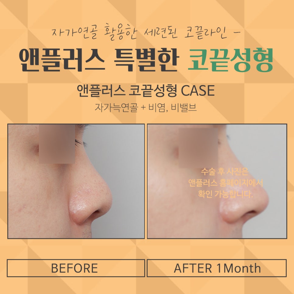 Nose Tip Surgery Review Found at Gangnam & Plus image 15