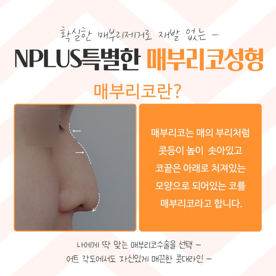 Hump Nose Surgery Review with a Clear Diagnosis image 4