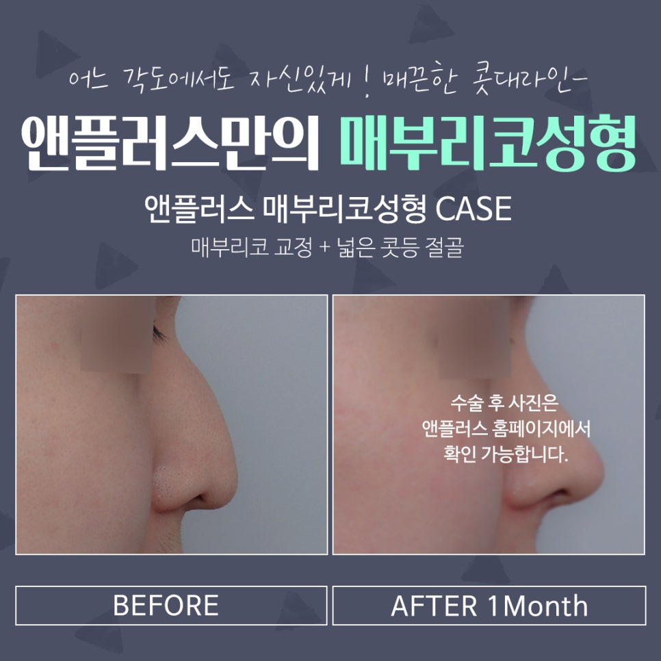 매부리코성형후기 매끈하고 예쁜코라인으로 관련 이미지 17