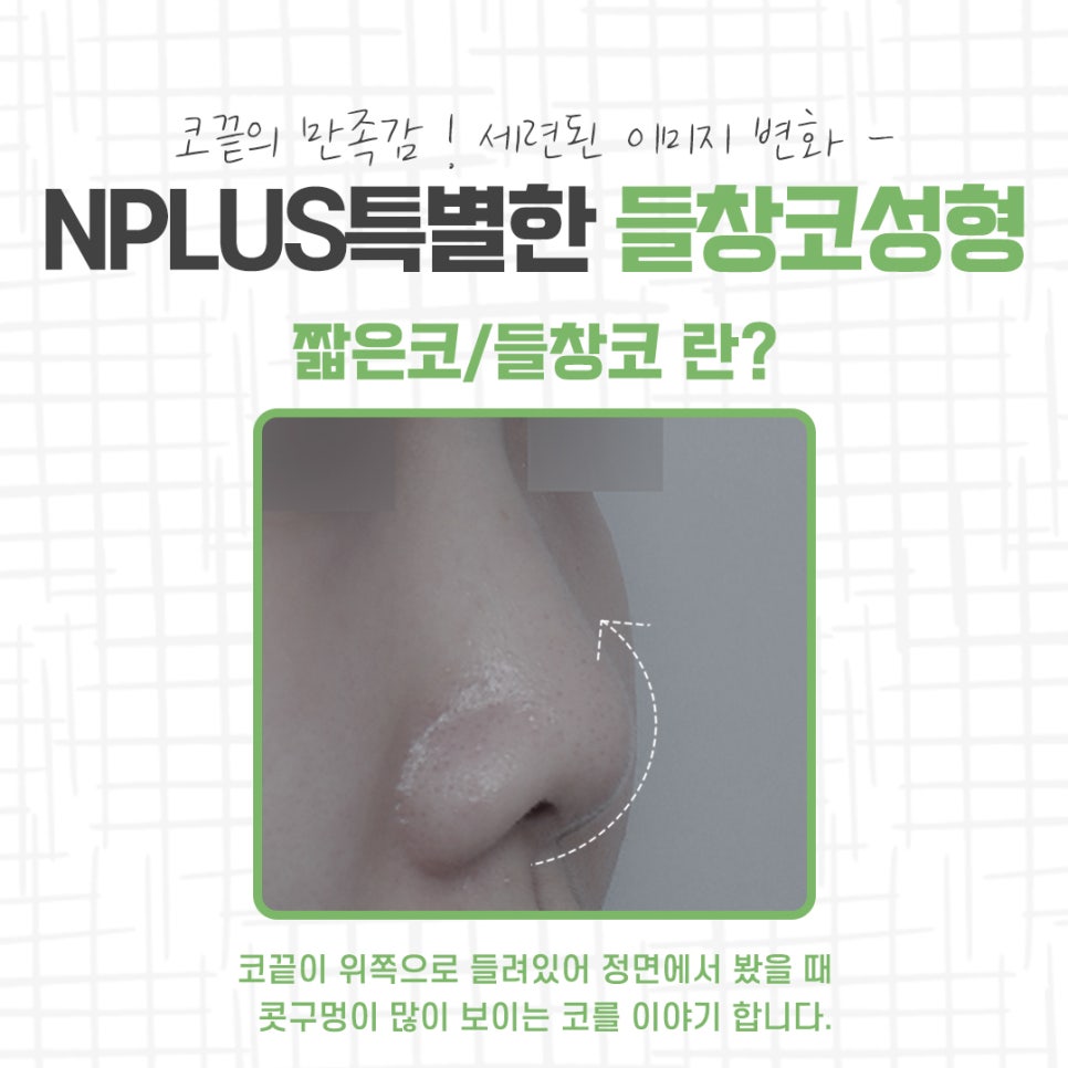 들창코성형 차이를 확인하고 관련 이미지 3