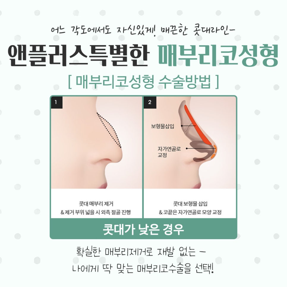 매부리코성형후기 코끝처짐을 개선하여 관련 이미지 10