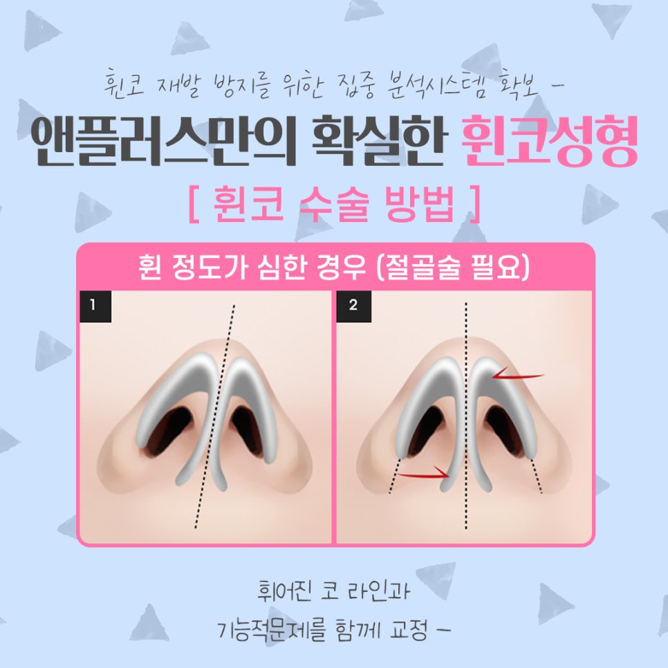 휜코성형 정확한 문제 파악으로 관련 이미지 10