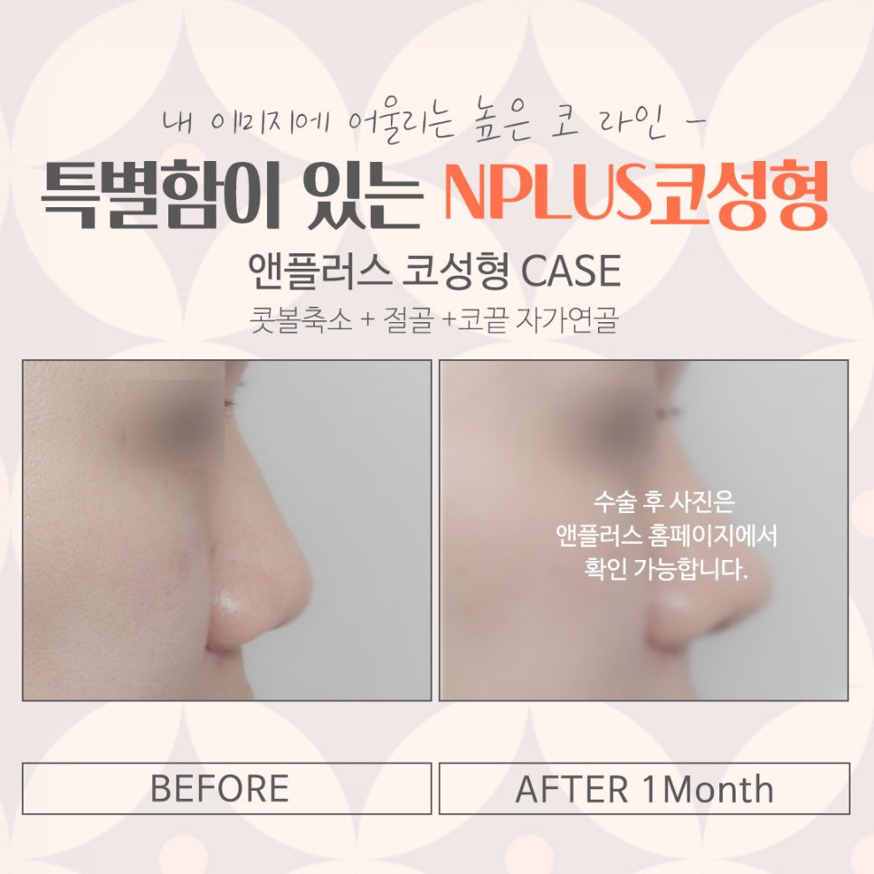 코성형잘하는병원의 차이를 알아보고 관련 이미지 14