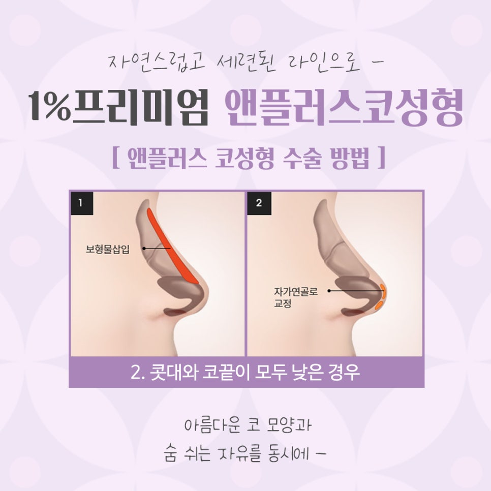 늑연골 코수술 자세하게 알아보고 관련 이미지 9