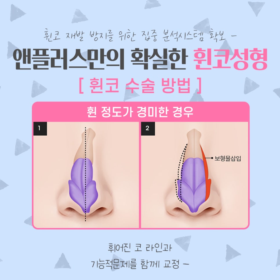 휜코성형 정확한 문제 파악으로 관련 이미지 9