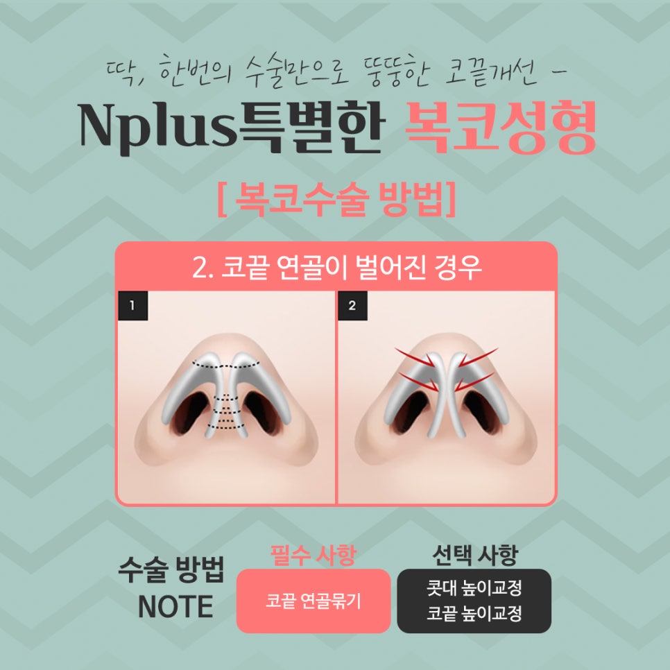 복코수술후기 세련된 인상으로 관련 이미지 9