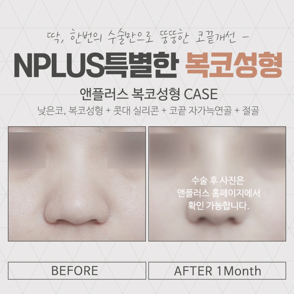 복코성형후기를 다양하게 찾아보고 관련 이미지 16