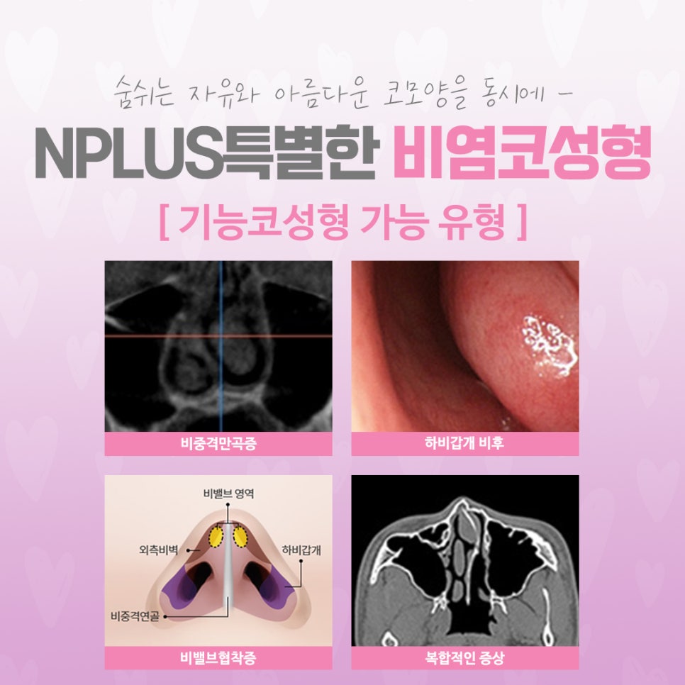 Learn in Detail About Rhinoplasty for Rhinitis image 4