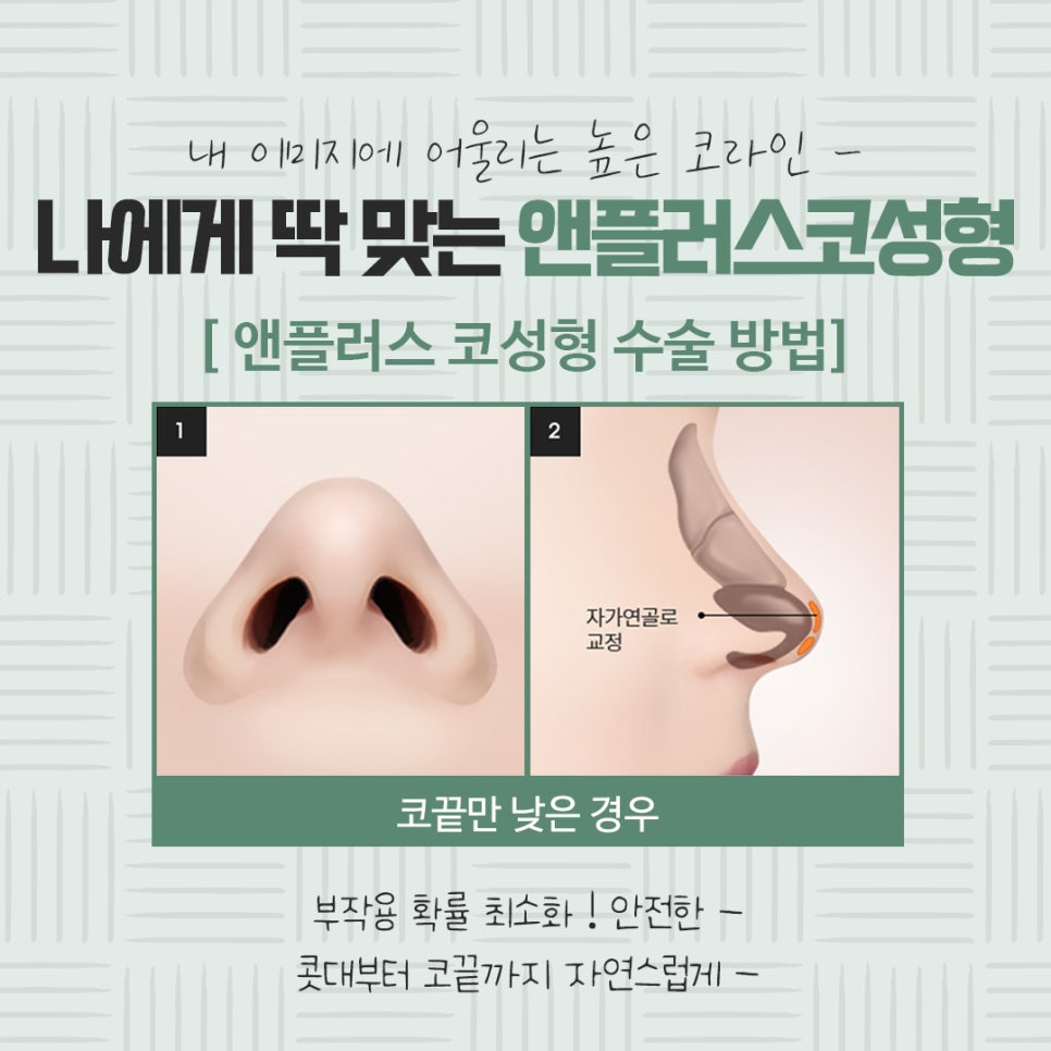 자가연골코수술로 세련되고 자연스럽게 관련 이미지 10