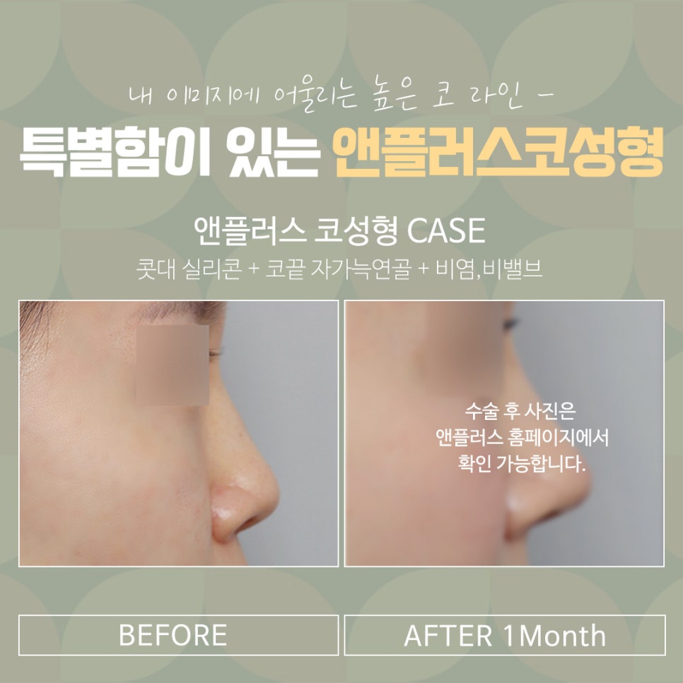 직반버선코 라인으로 교정된 코수술후기 관련 이미지 18