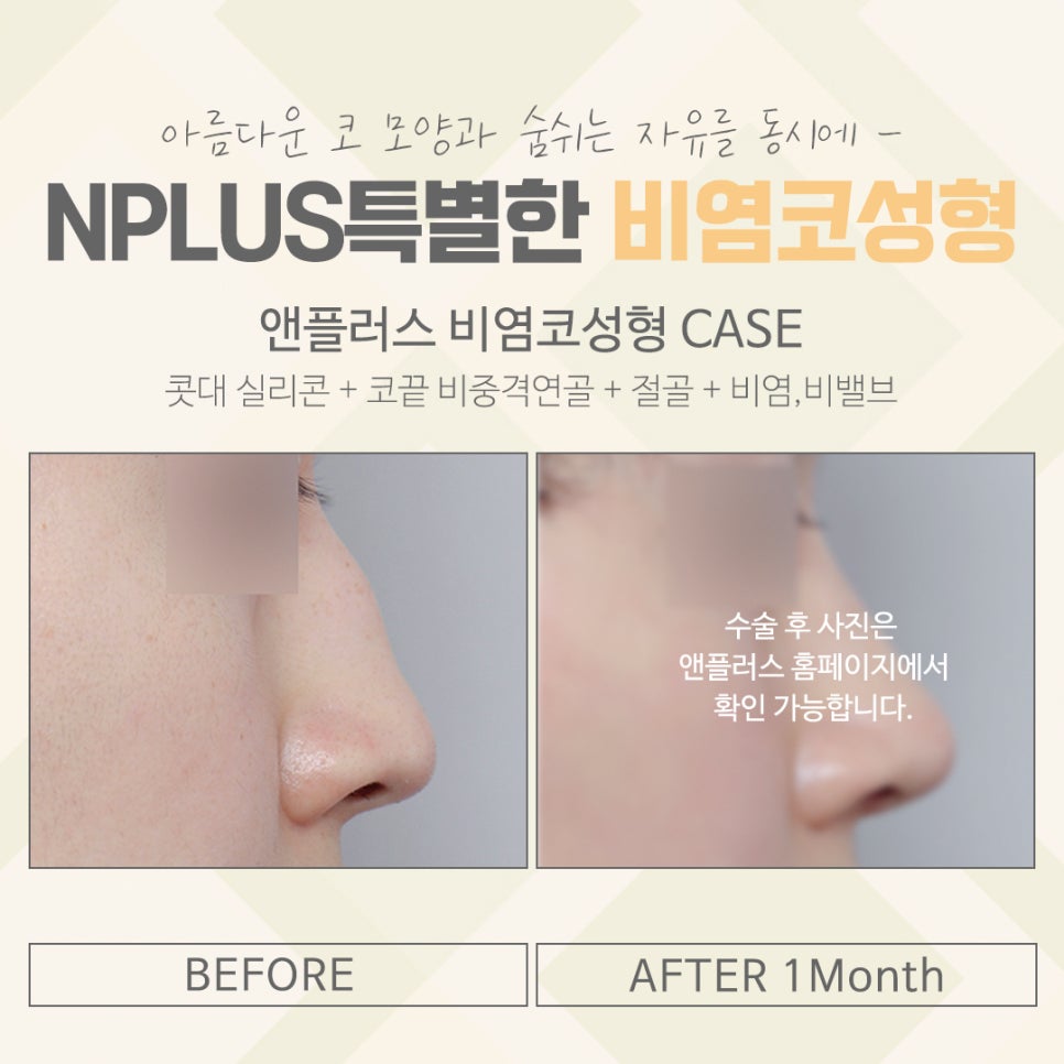 비염코수술후기를 잘 알아보고 관련 이미지 14