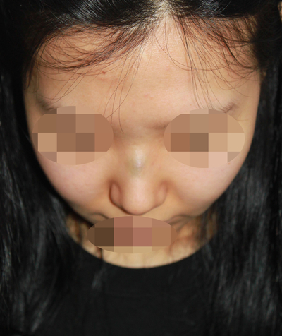 1_여자 매부리코 수술전후 관련 이미지 6