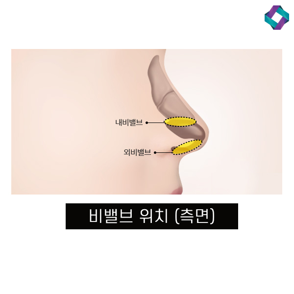 비염수술코성형 비밸브 교정술! 관련 이미지 6