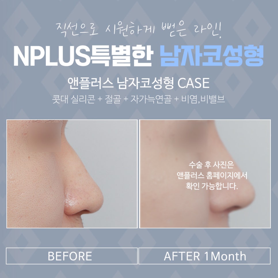 Male Nose Surgery Review: You Should Also Look into Function image 15