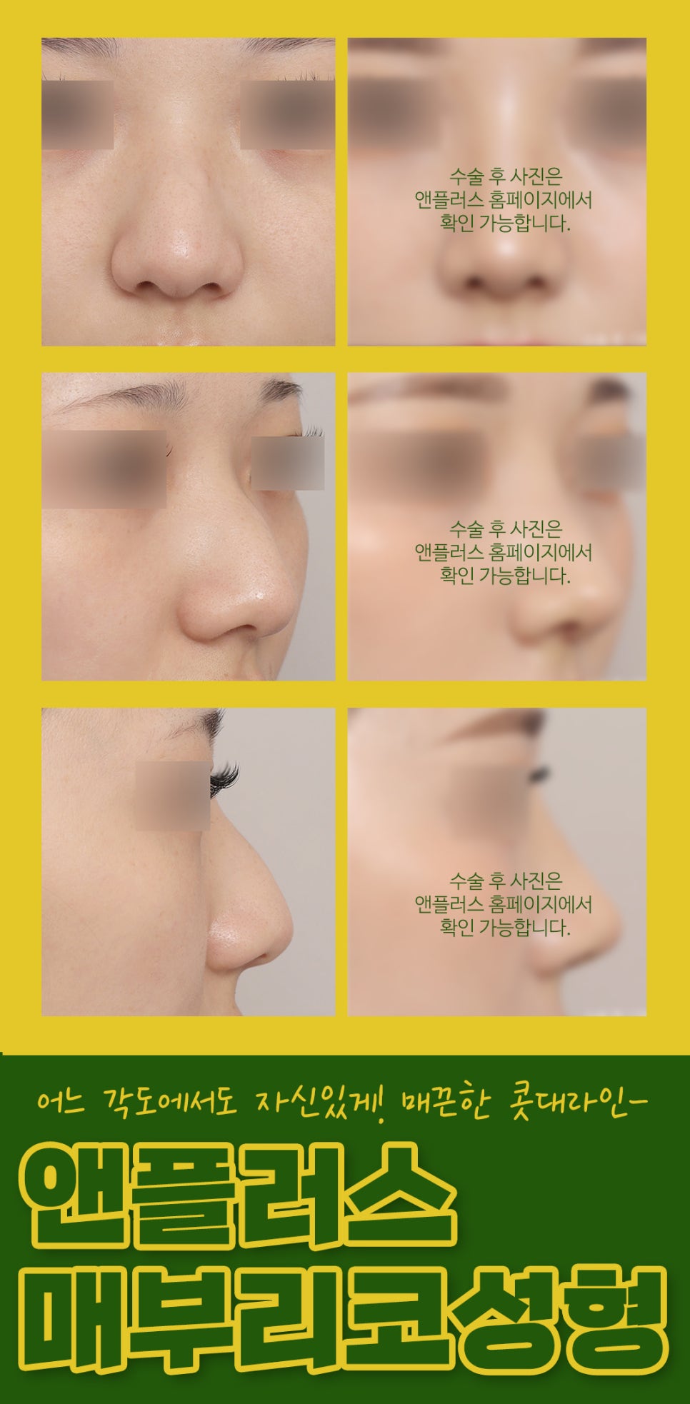 매부리코교정후기_깔끔하게 제거해야 관련 이미지 4