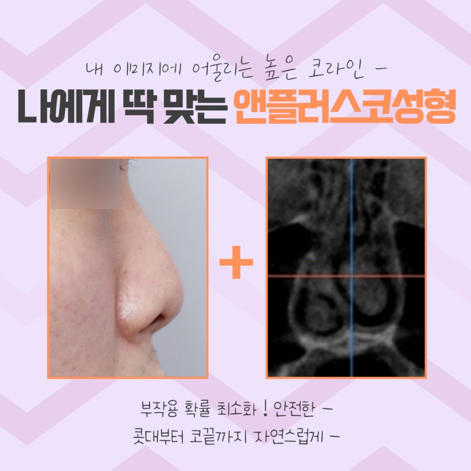 코수술후기 코 내부까지 확실하게 알아보고 관련 이미지 5