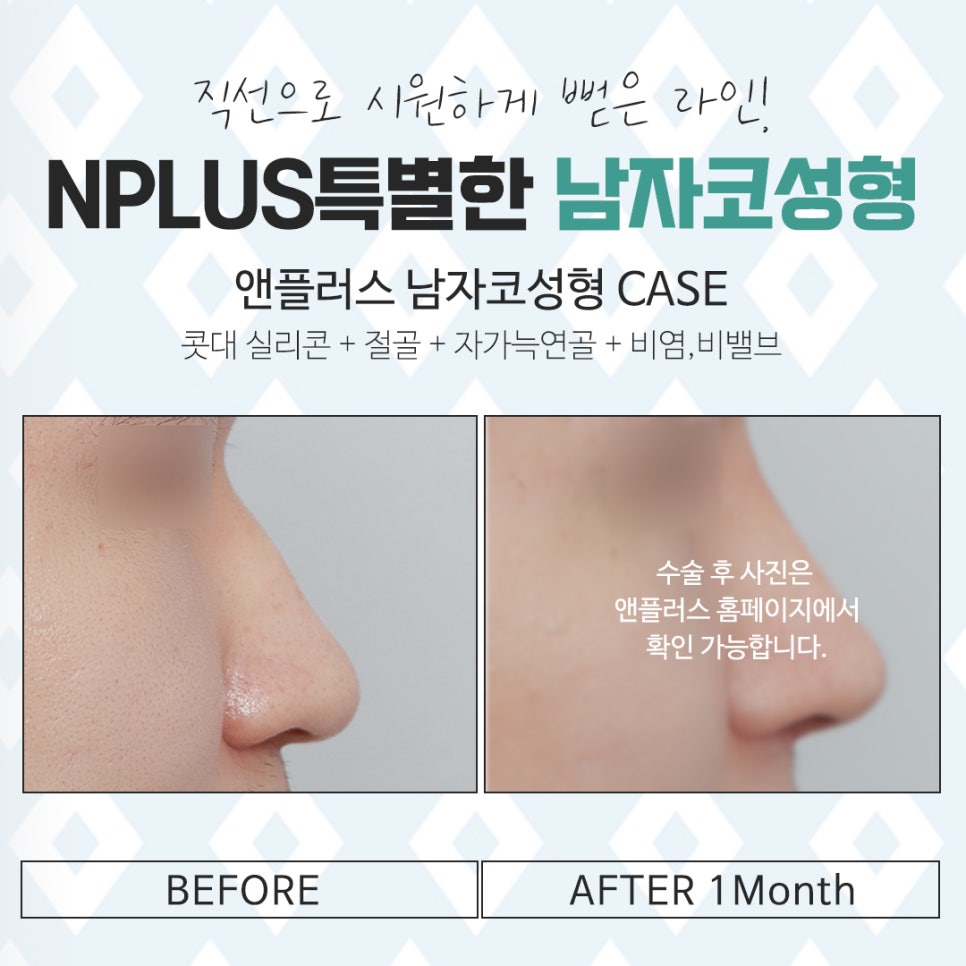 Learn More About Before and After Male Nose Surgery in Detail image 15