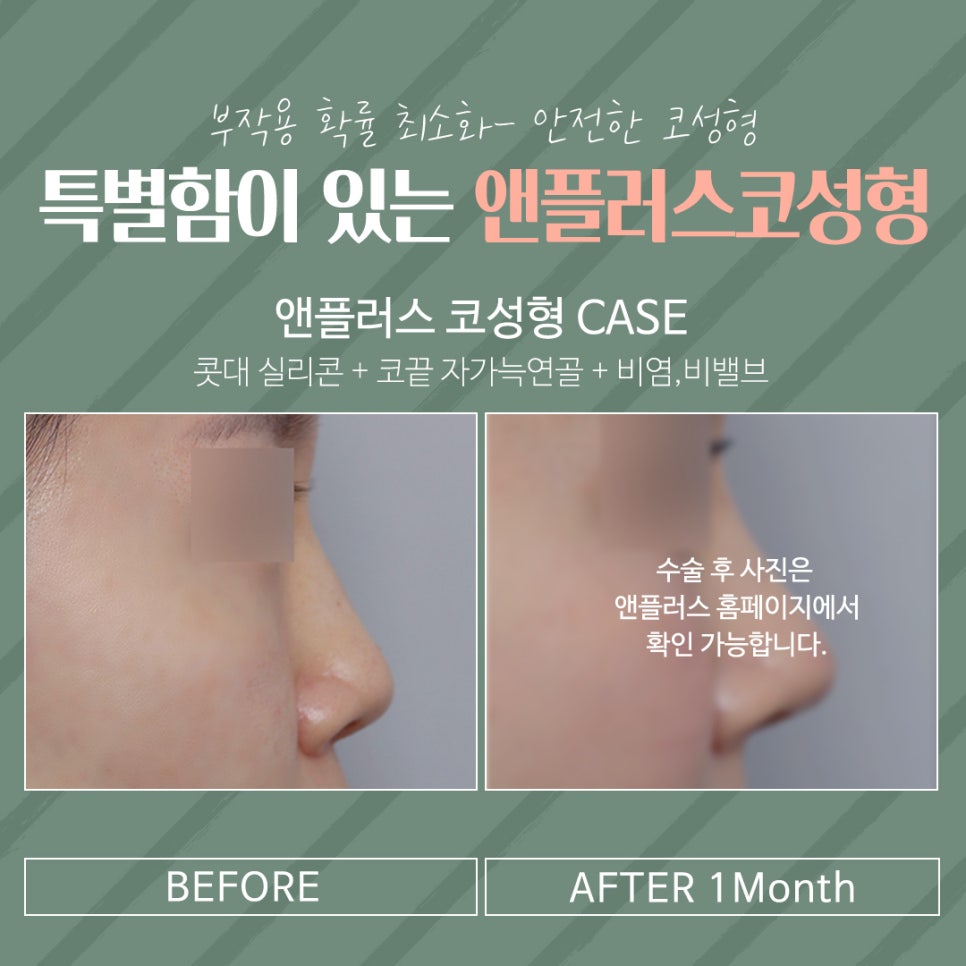 Beautiful and Natural with Autologous Cartilage Rhinoplasty image 16