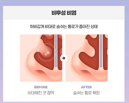 Learn More About Functional Rhinoplasty Events in Detail image 9