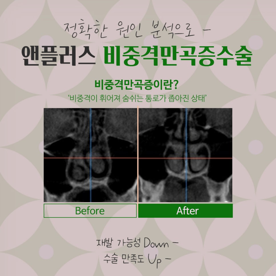 비중격만곡증 수술방법 확인하여 관련 이미지 5