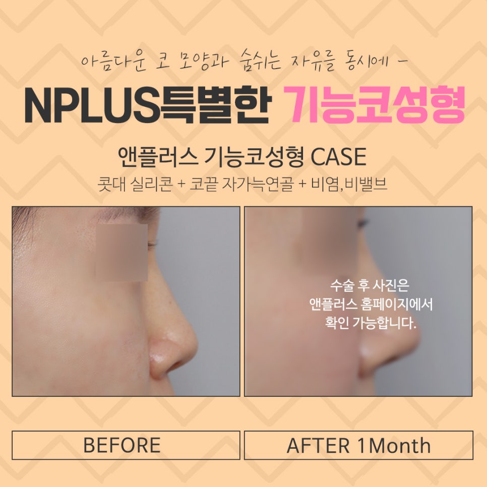 Functional Nose Surgery Reviews with Improved Nasal Line image 15