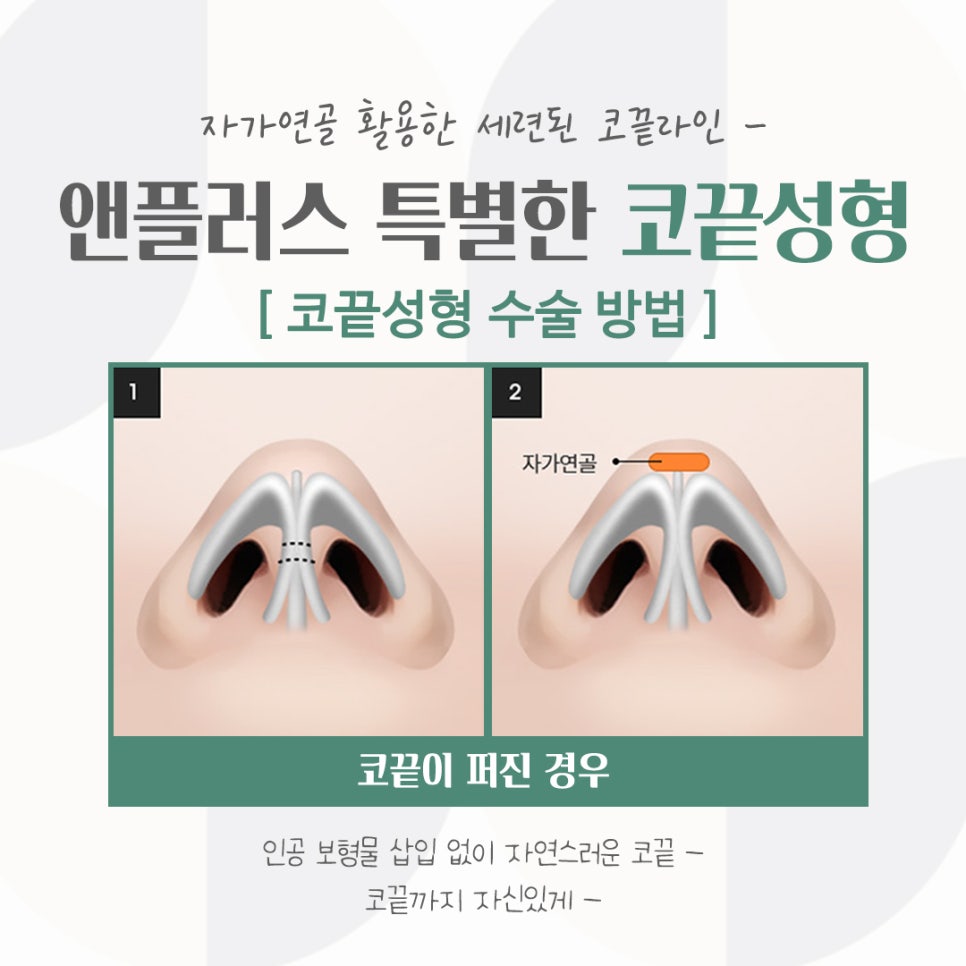 코끝연골묶기로 자연스러운 코라인 관련 이미지 10