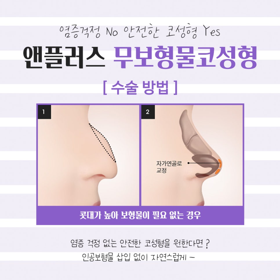 무보형물코성형후기 만족스러운 라인으로 관련 이미지 9