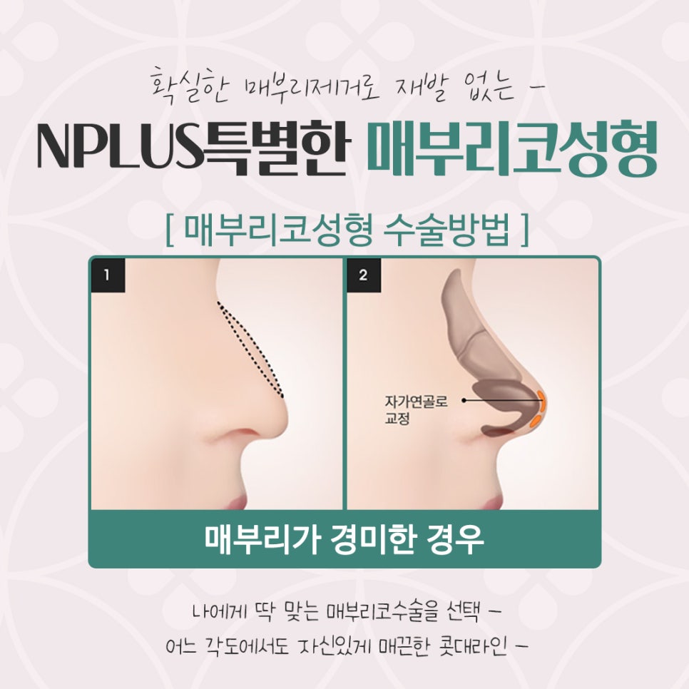 매부리코성형후기 다양한 내용을 찾아보고 관련 이미지 10
