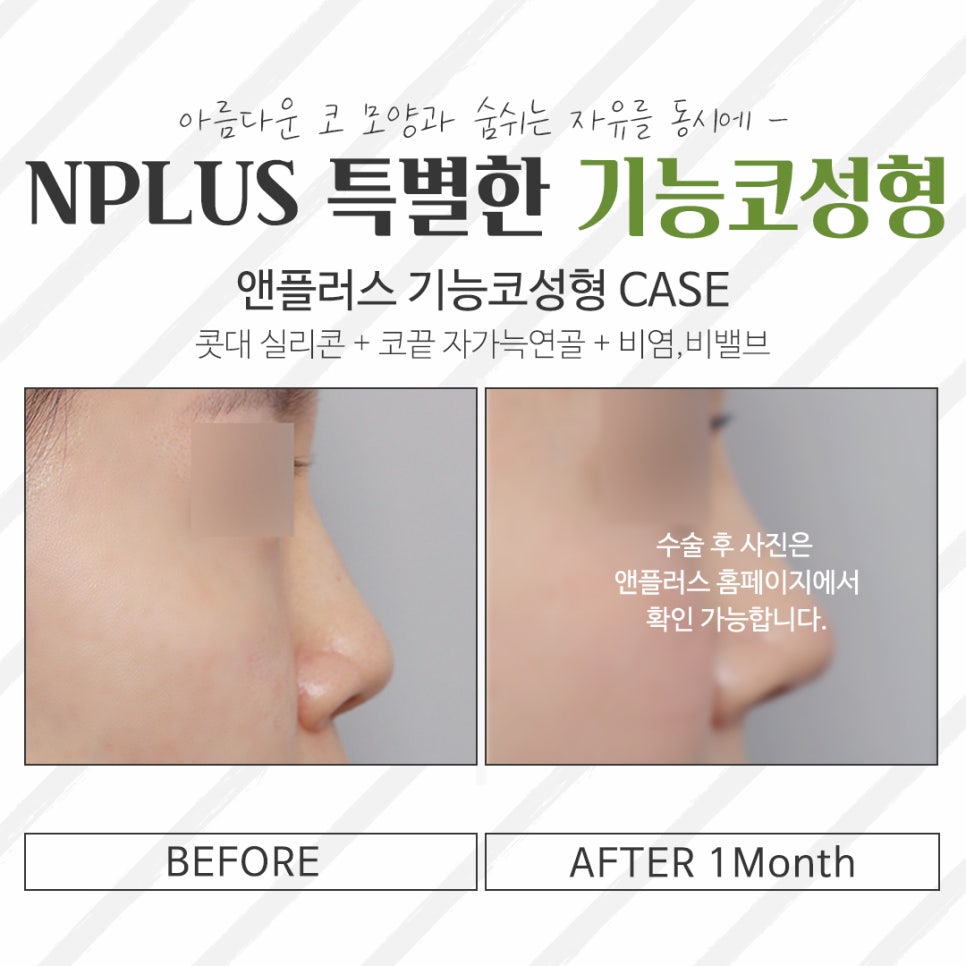 The Importance of Choosing a Female Rhinoplasty Review image 12
