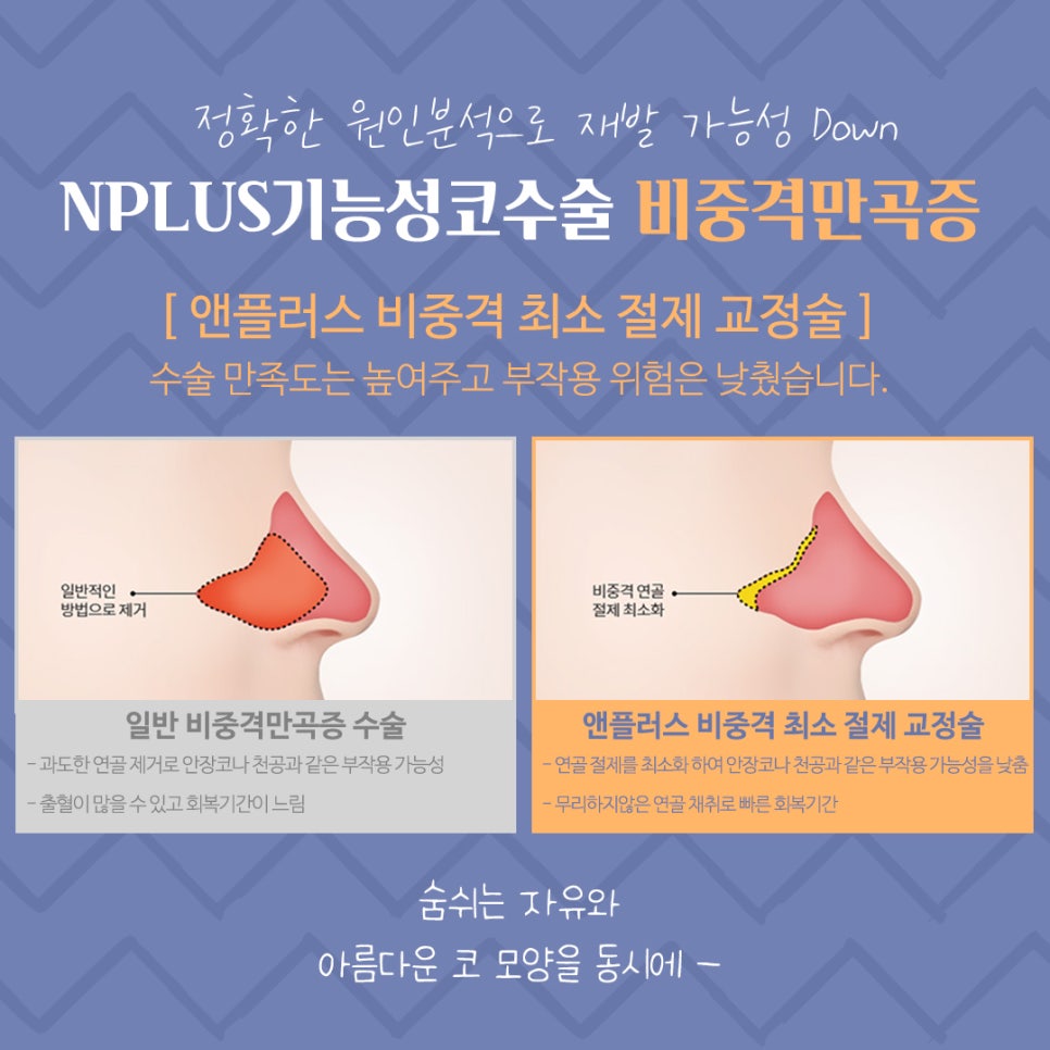 비중격만곡증수술 후기까지 꼼꼼하게 알아보고 관련 이미지 8