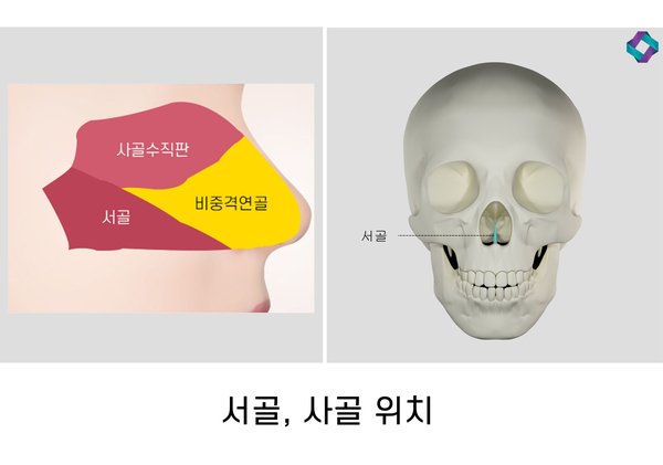 기능코성형 비중격만곡증(비중격교정술)과 코막힘원인 관련 이미지 3