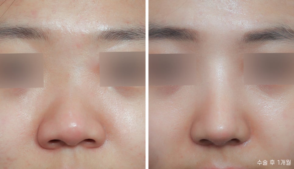 낮은코성형 비염수술도 예쁘게 관련 이미지 2