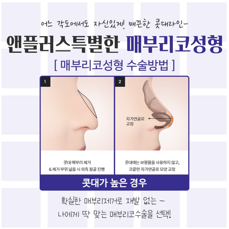 An Image Changed by Hump Nose Surgery Reviews image 9