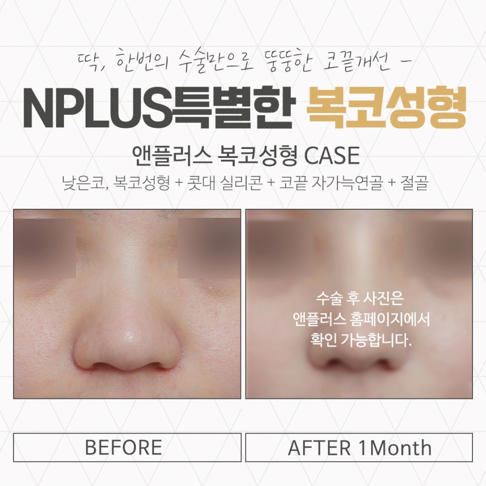 Taking a Thorough Look at Bulbous Nose Surgery Reviews image 16