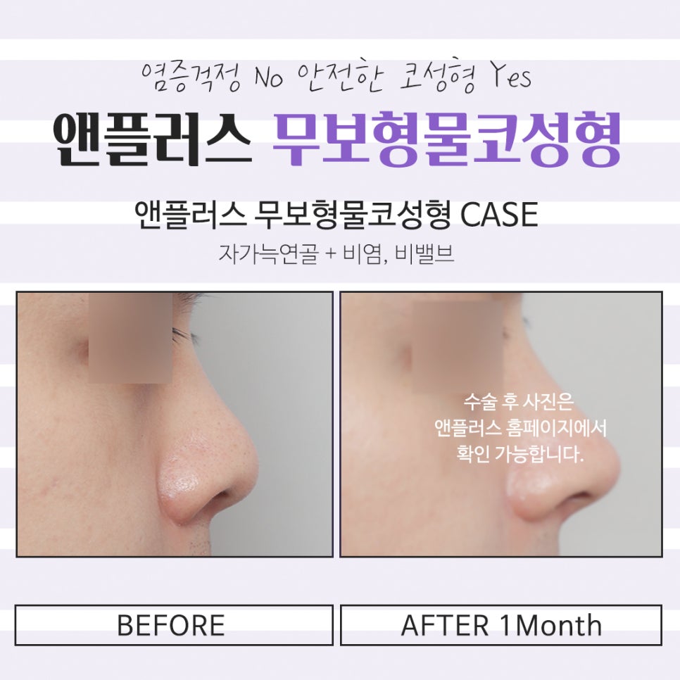 무보형물코성형후기 만족스러운 라인으로 관련 이미지 14