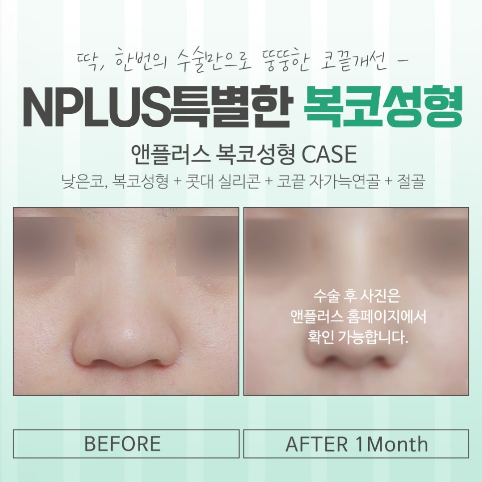 복코수술후기 다양하게 알아보고 관련 이미지 6